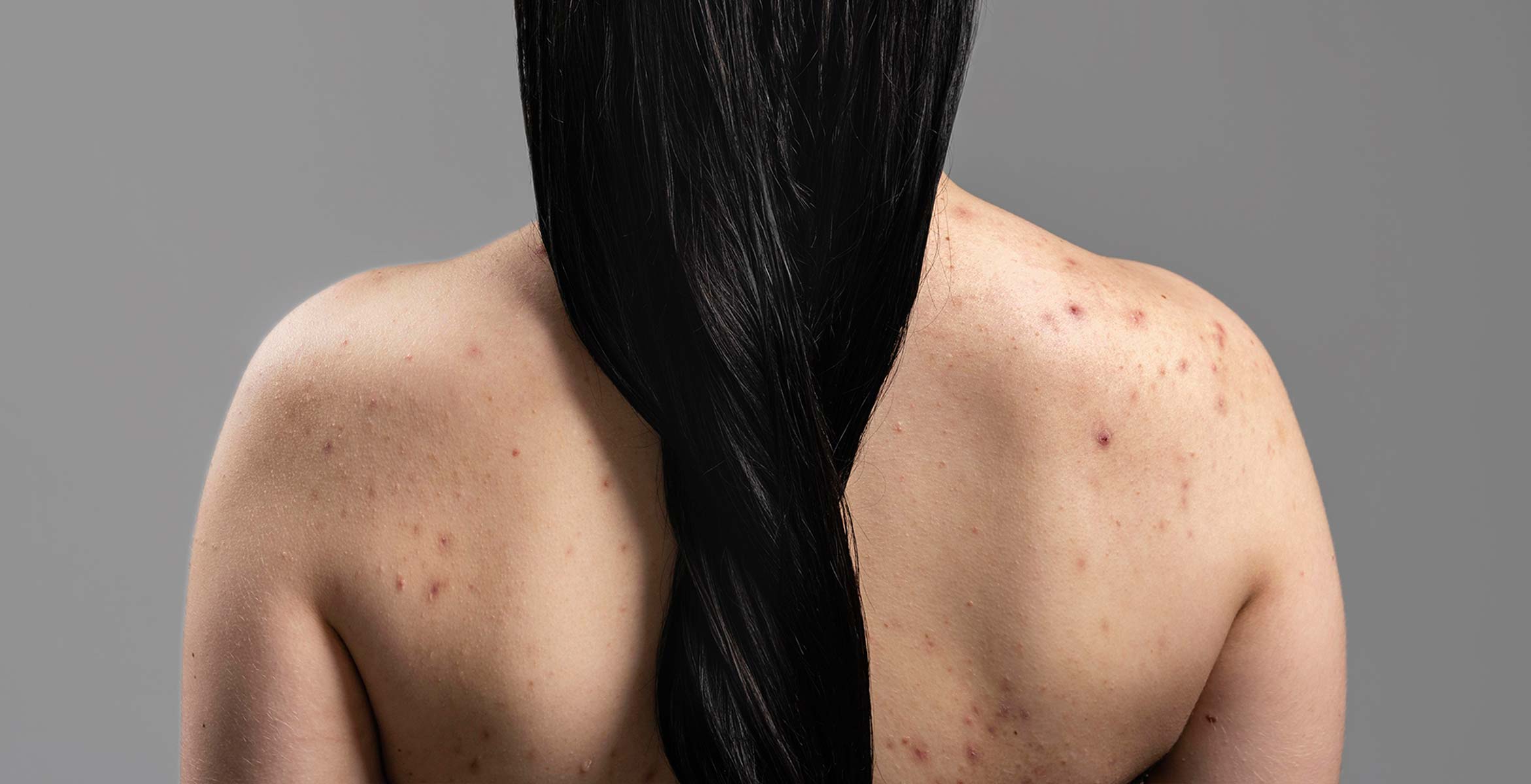 cómo tratar acné en la espalda