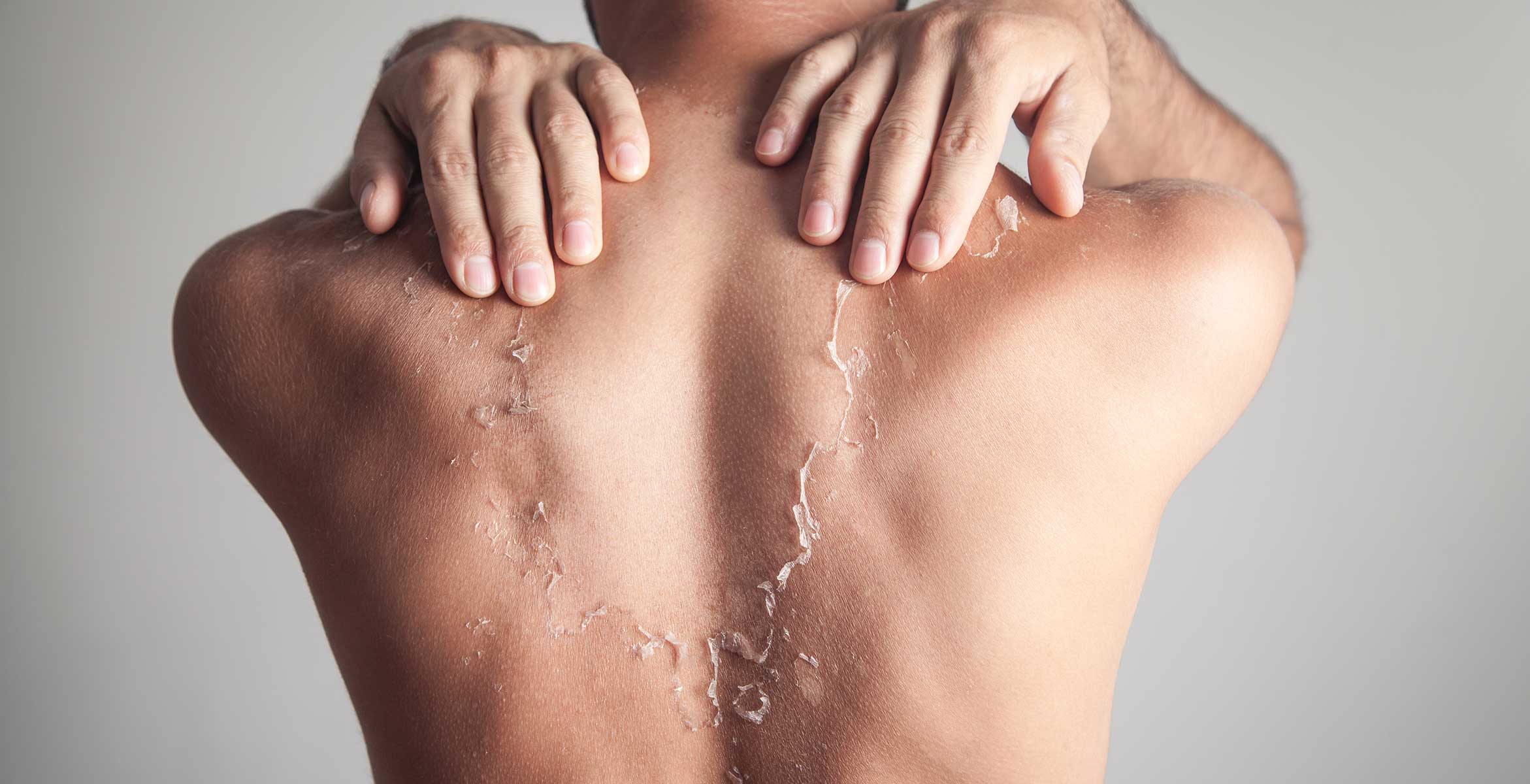 Cómo tratar la Eritema Solar