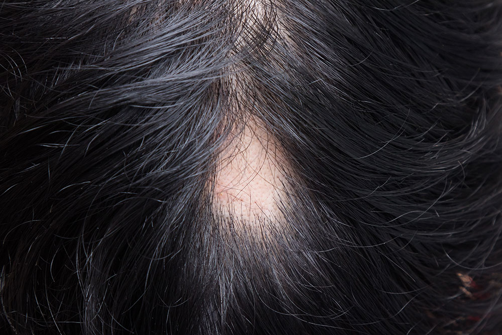 cuero cabelludo dañado: alopecia