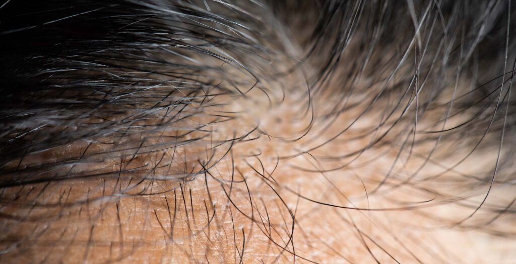 cuidado cuero cabelludo