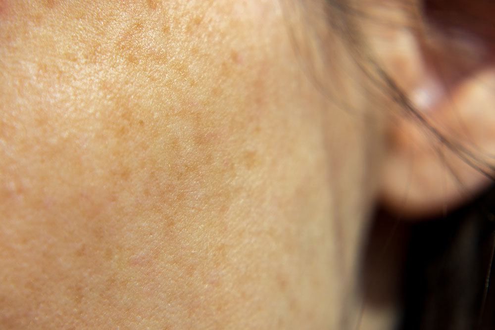 problemas de hiperpigmentación