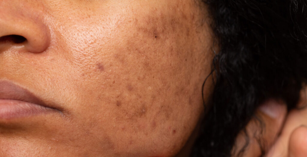 7 Formas de Mantener a Raya el Melasma Facial y el Tono de Piel Irregular