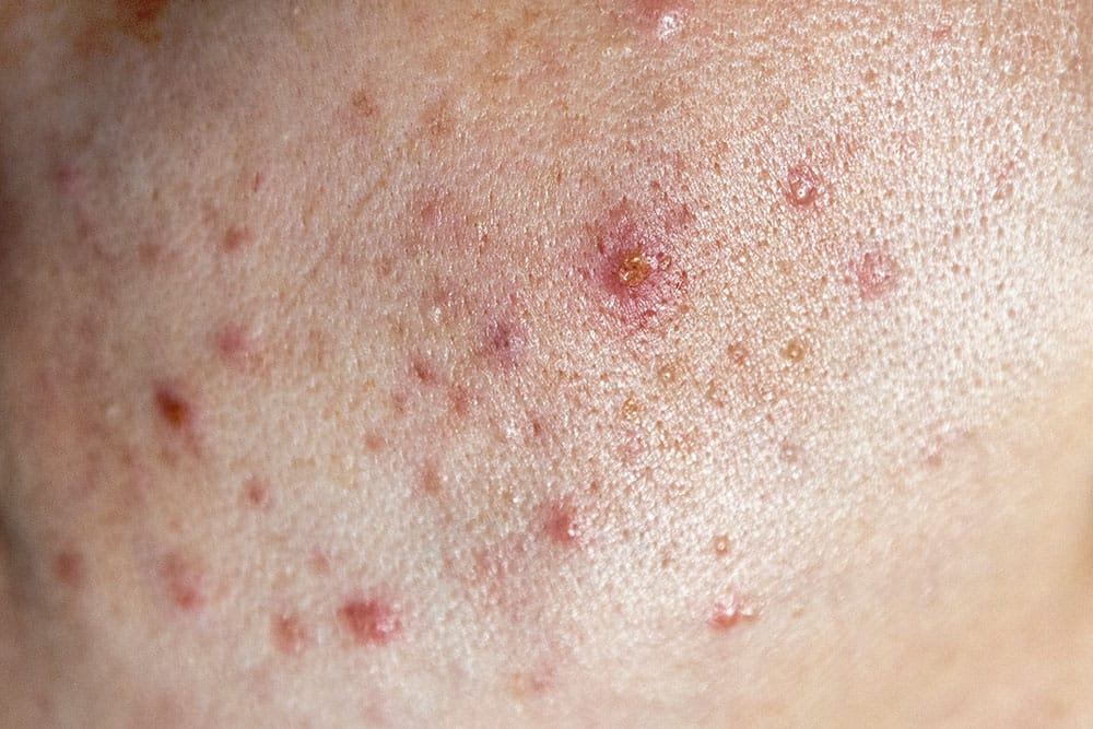 acne y la piel grasa mixta