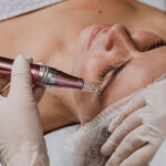 pros y contras de microneedling